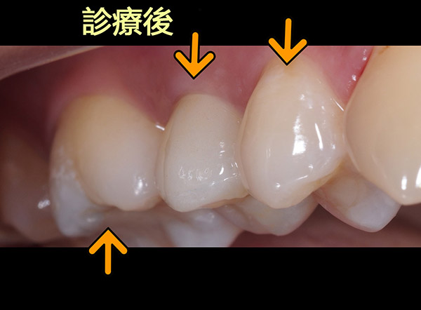 全鋯冠假牙