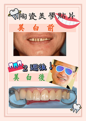 【牙齒美白案例】陶瓷美學貼片